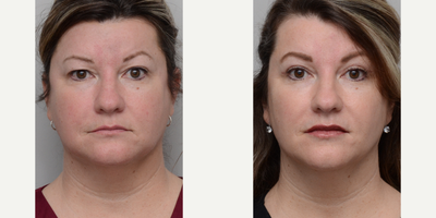 Lip Fillers before and after photo