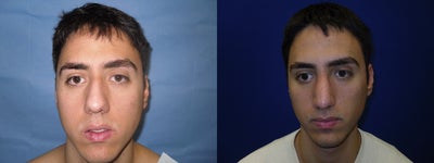 Rhinoplasty before and after photo