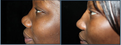 Rhinoplasty before and after photo