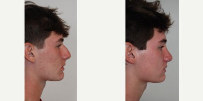 Rhinoplasty before and after photo