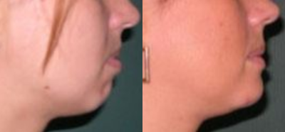 Chin Implant before and after photo