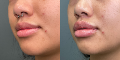 Dermal Fillers before and after photo