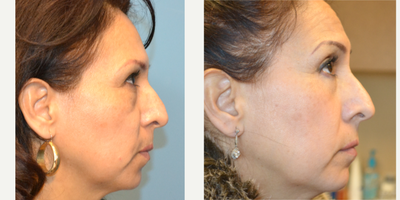 Eyelid Surgery before and after photo
