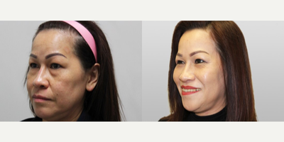 Eyelid Surgery before and after photo
