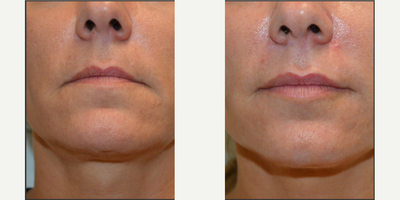 Juvederm before and after photo