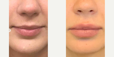 Lip Fillers before and after photo