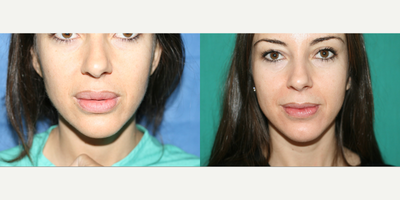 Lip Reduction before and after photo
