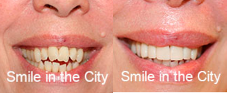 Smile Makeover before and after photo