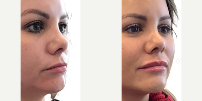Lip Fillers before and after photo