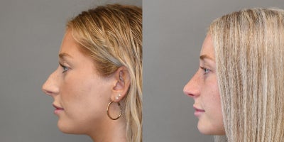 Rhinoplasty before and after photo