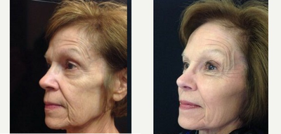 Voluma before and after photo