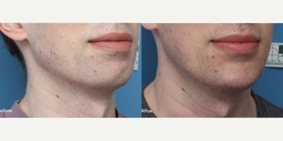 Chin Implant before and after photo
