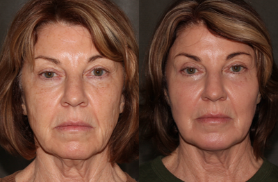 CO2 Laser before and after photo