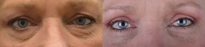 Eyelid Surgery before and after photo