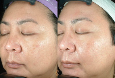 Fraxel Laser before and after photo