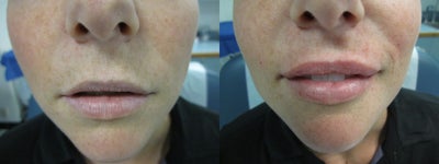 Restylane before and after photo