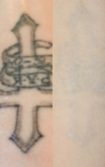 Tattoo Removal before and after photo