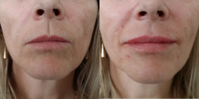 Belotero before and after photo