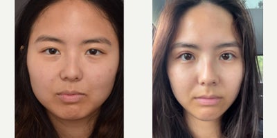 Eyelid Surgery before and after photo