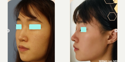 Asian Rhinoplasty before and after photo