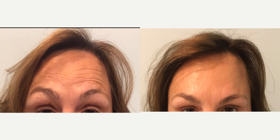 Botox before and after photo