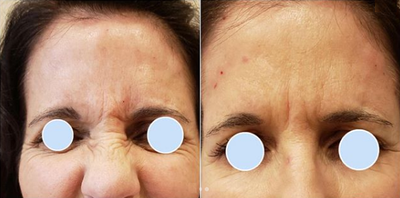 Botox before and after photo