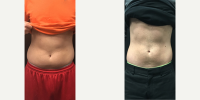 CoolSculpting before and after photo