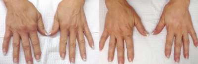 Dermal Fillers before and after photo