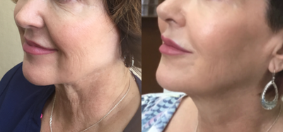 EndyMed 3Deep before and after photo