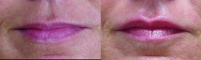 Lip Fillers before and after photo