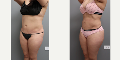Lipo 360 BBL before and after photo