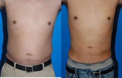Liposuction before and after photo