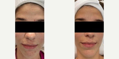 Microneedling before and after photo