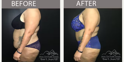 Tummy Tuck before and after photo
