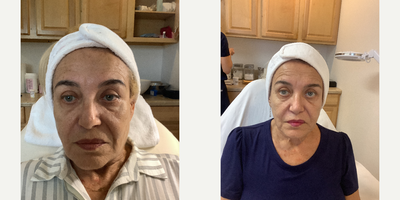 Virtue RF before and after photo