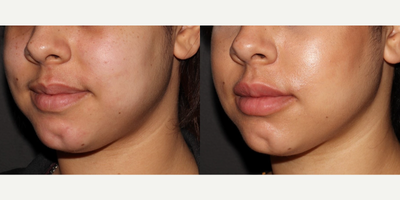 Dermal Fillers before and after photo