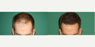 FUE Hair Transplant before and after photo