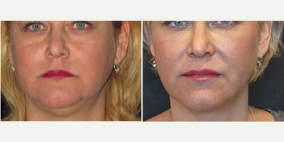 Kybella before and after photo
