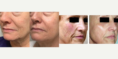 Laser Resurfacing before and after photo