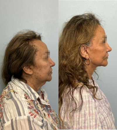 Neck Lift before and after photo