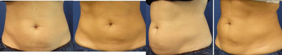 CoolSculpting before and after photo