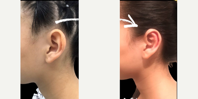 Ear Surgery before and after photo