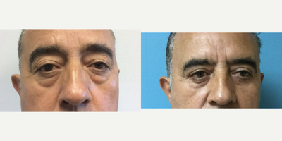Eyelid Surgery before and after photo