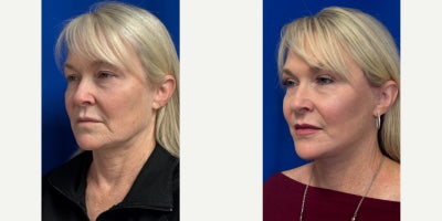 Facelift before and after photo