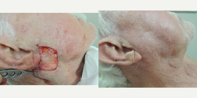 Mohs Surgery before and after photo