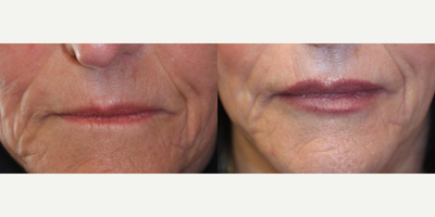 Lip Fillers before and after photo
