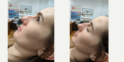 Nonsurgical Nose Job before and after photo