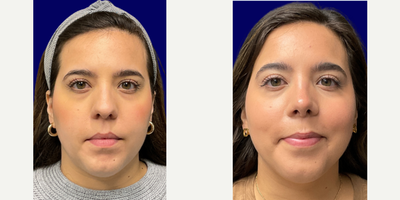 Rhinoplasty before and after photo