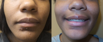 Scar Removal before and after photo
