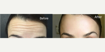 Botox before and after photo